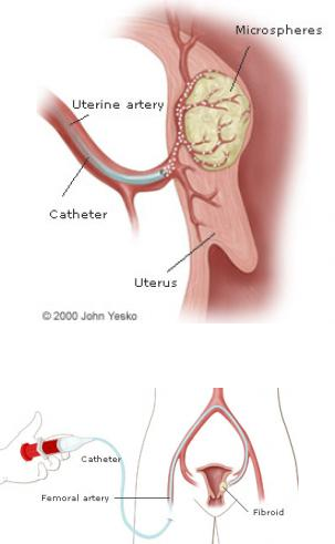 Uterine Fibroid Embolization