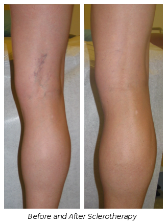 Sclerotherapy to Reduce Varicose Veins