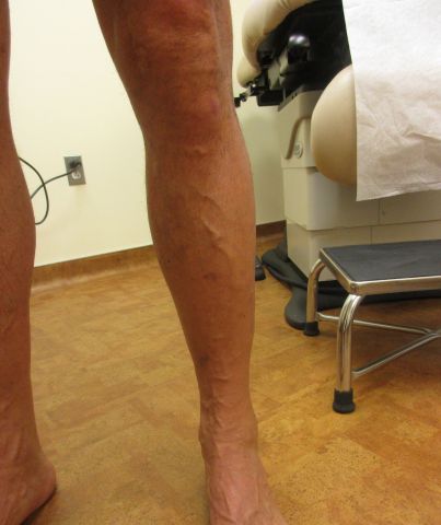 left leg after procedure