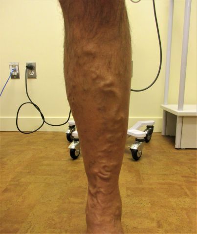 left leg before procedure