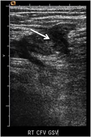 dvt on ultrasound arrow