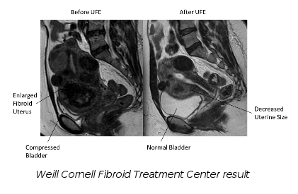 Uterine Fibroids Diagnosis