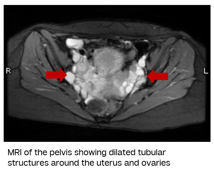 Interventional Radiology Group - Pelvic Vein Embolization is an effective  treatment for Pelvic Congestion Syndrome in Women! Pelvic congestion  syndrome occurs when pelvic veins become swollen and painful due to low  blood