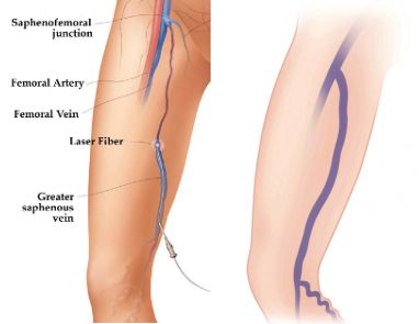 venacure elvt in leg and endovenous laser treatment